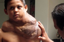 تومور چندکیلویی بر دوش پسر 11ساله+عکس