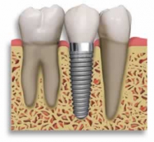 ایمپلنت دندان بایدها و نبایدها