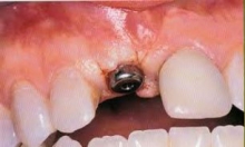30 درصد قيمت ايمپلنت هاي دنداني كاهش مي يابد 