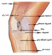 تعویض مفصل برای حذف درد زانو