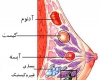 تشخیص درست در مرحله نخست بیماری است